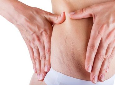 They keep appearing out of nowhere! They attack belly, thighs, buttocks and even breasts… THE STRETCH MARKS! Transversal stripes that are hard to get rid of. Where do they come from? How to combat stretch marks? Can we do this at home? Are stretch marks hazardous to our health? Today we’re going to deal with […]