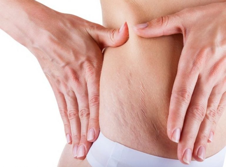 Troublesome tiger stripes. How to remove stretch marks