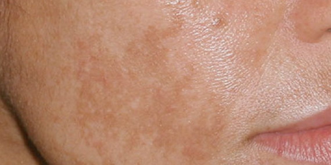 How to get rid of skin discolourations? Cosmetics and treatments that will help you