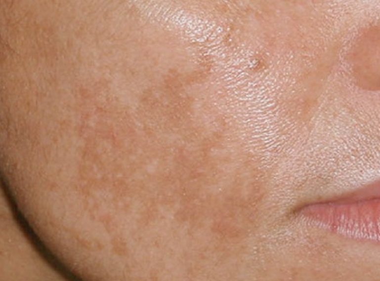 How to get rid of skin discolourations? Cosmetics and treatments that will help you