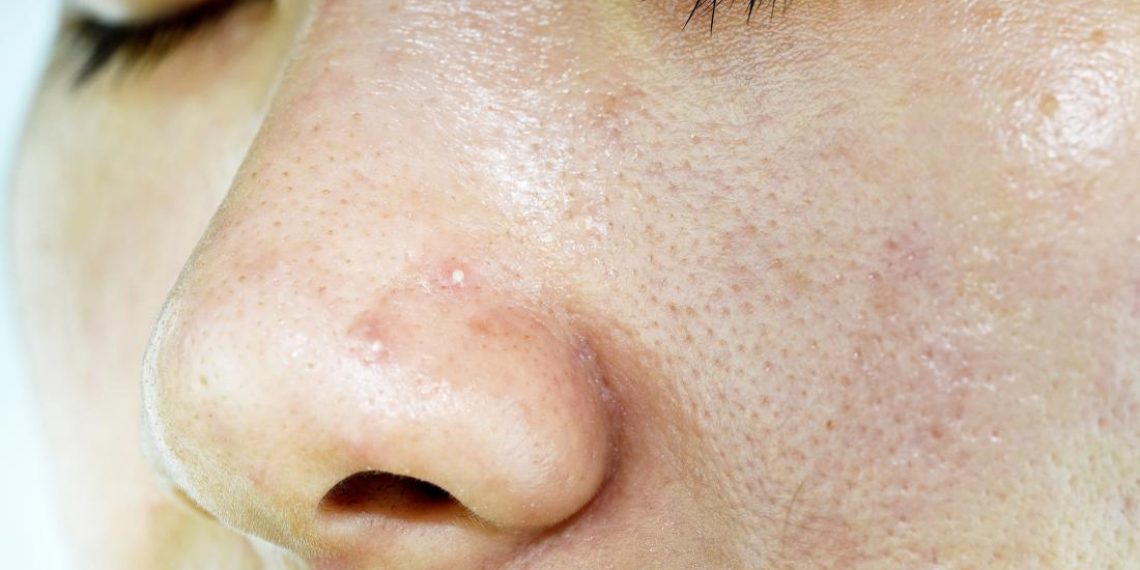 How to treat oily skin? These methods will surely help you