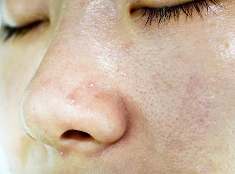 How to treat oily skin? These methods will surely help you